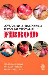 Apa Yang Anda Perlu Tahu Tentang Fibroid
